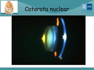 Catarata nuclear
 