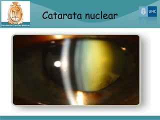 Catarata nuclear
 