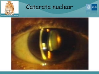 Catarata nuclear
 