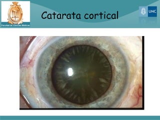 Catarata cortical
 