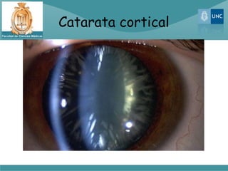Catarata cortical
 