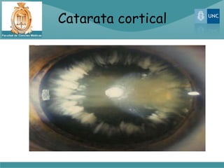 Catarata cortical
 