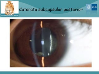 Catarata subcapsular posterior
 