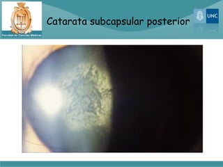 Catarata subcapsular posterior
 