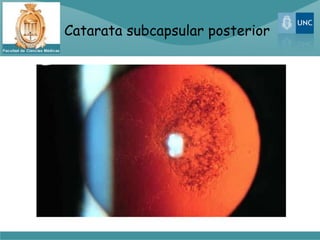 Catarata subcapsular posterior
 