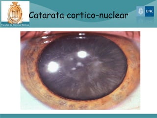 Catarata cortico-nuclear
 