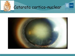 Catarata cortico-nuclear
 