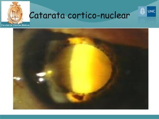 Catarata cortico-nuclear
 