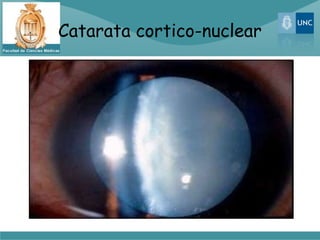 Catarata cortico-nuclear
 
