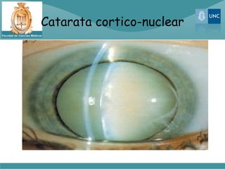 Catarata cortico-nuclear
 