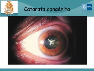 Catarata congénita
 