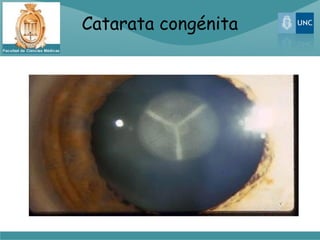Catarata congénita
 