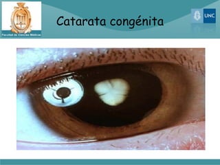 Catarata congénita
 