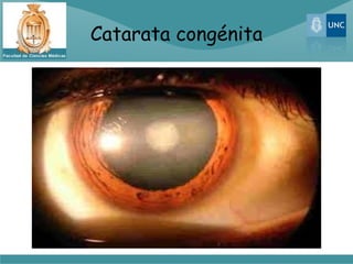 Catarata congénita
 