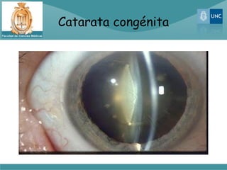 Catarata congénita
 