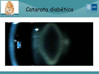 Catarata diabética
 