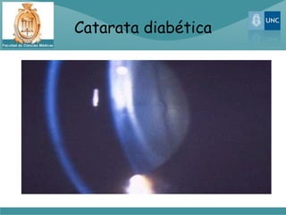 Catarata diabética
 