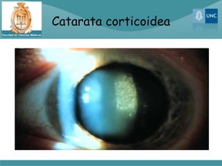 Catarata corticoidea
 