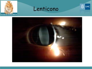 Lenticono
 