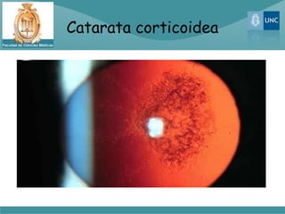 Catarata corticoidea
 