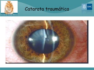 Catarata traumática
 