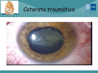 Catarata traumática
 