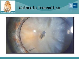 Catarata traumática
 
