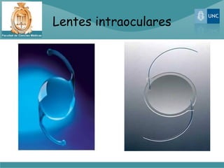 Lentes intraoculares
 