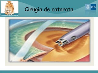 Cirugía de catarata
 