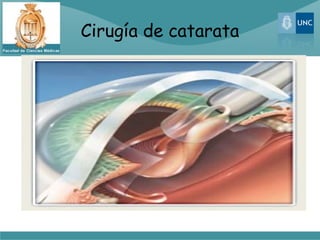 Cirugía de catarata
 