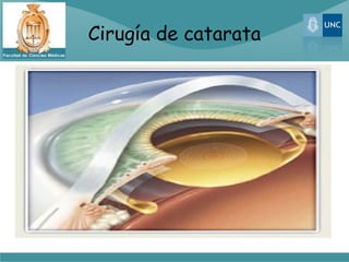 Cirugía de catarata
 
