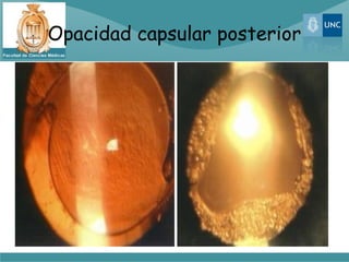 Opacidad capsular posterior
 