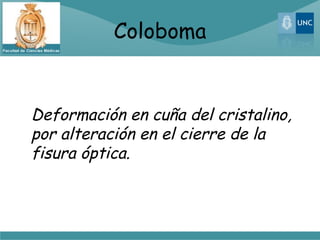 Coloboma


Deformación en cuña del cristalino,
por alteración en el cierre de la
fisura óptica.
 