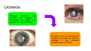 CATARATA
Patología congénita más
frecuente del cristalino y
considerada la causa más
frecuente de ceguera tratable
Se define como una opacidad del
cristalino que puede ser parcial o
completa y que interferirá
variablemente en la visión
 