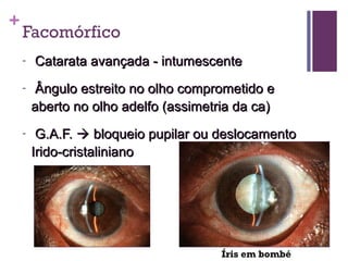 +
Facomórfico
- Catarata avançada - intumescenteCatarata avançada - intumescente
- Ângulo estreito no olho comprometido eÂngulo estreito no olho comprometido e
aberto no olho adelfo (assimetria da ca)aberto no olho adelfo (assimetria da ca)
- G.A.F.G.A.F.  bloqueio pupilar ou deslocamentobloqueio pupilar ou deslocamento
Irido-cristalinianoIrido-cristaliniano
Íris em bombé
 