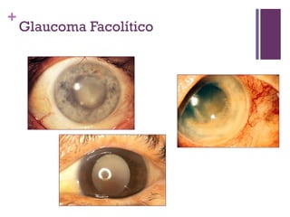 +
Glaucoma Facolítico
 
