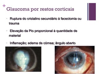 +
Glaucoma por restos corticais
- Ruptura do cristalino secundário à facectomia ouRuptura do cristalino secundário à facectomia ou
traumatrauma
- Elevação da Pio proporcional à quantidade deElevação da Pio proporcional à quantidade de
materialmaterial
- Inflamação; edema de córnea; ângulo abertoInflamação; edema de córnea; ângulo aberto
- fragmentos de córtexfragmentos de córtex
 