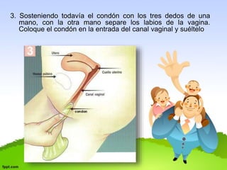 3. Sosteniendo todavía el condón con los tres dedos de una 
mano, con la otra mano separe los labios de la vagina. 
Coloque el condón en la entrada del canal vaginal y suéltelo 
 