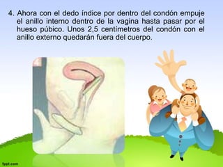 4. Ahora con el dedo índice por dentro del condón empuje 
el anillo interno dentro de la vagina hasta pasar por el 
hueso púbico. Unos 2,5 centímetros del condón con el 
anillo externo quedarán fuera del cuerpo. 
 