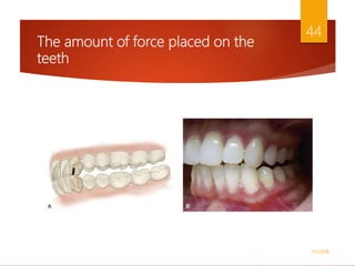 The amount of force placed on the
teeth
1/5/2018
44
 