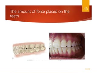 The amount of force placed on the
teeth
1/5/2018
46
 