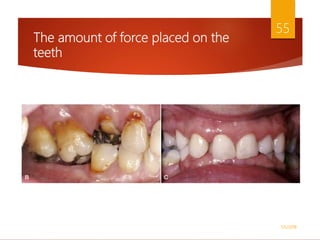 The amount of force placed on the
teeth
1/5/2018
55
 