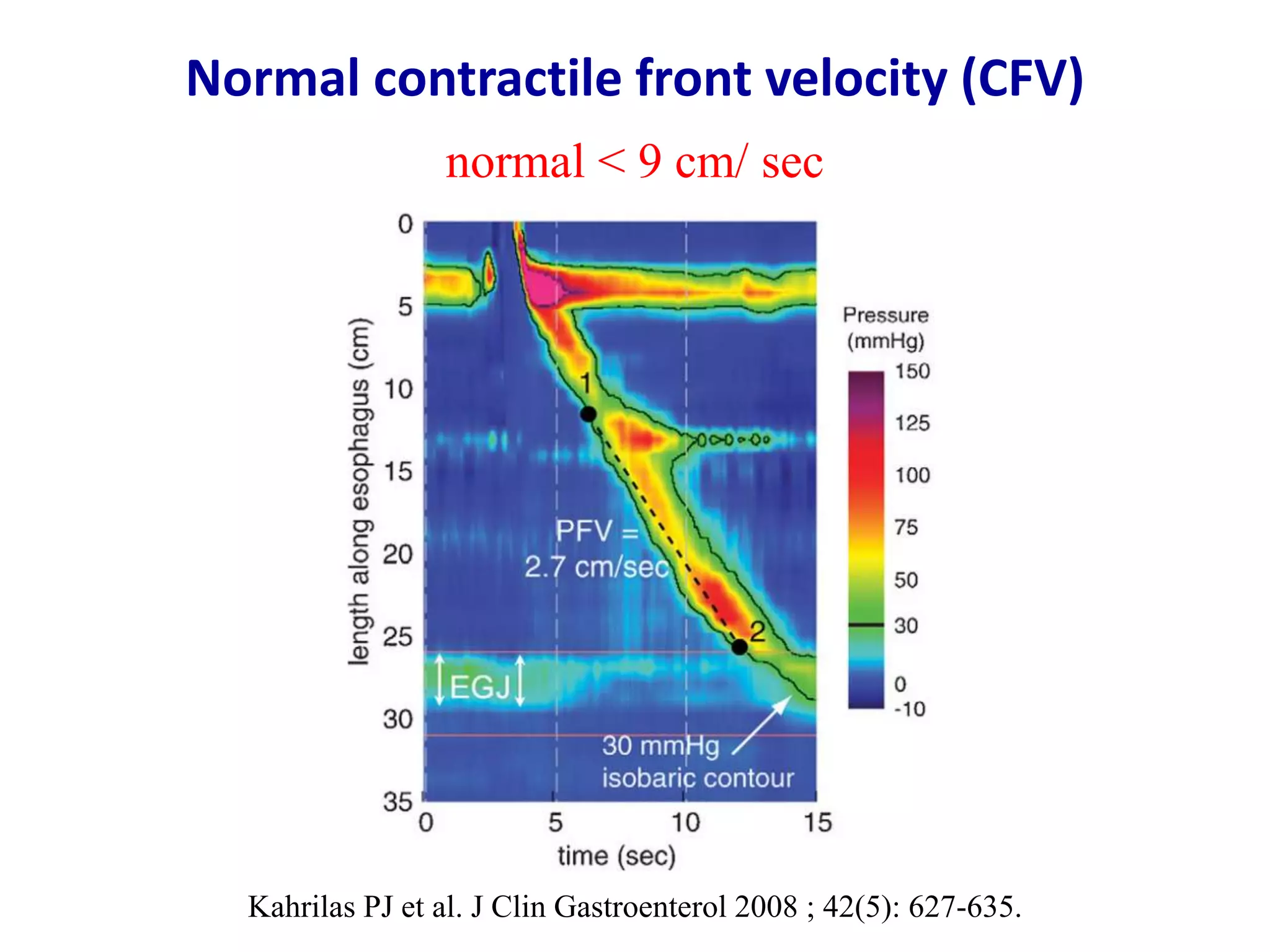 Normal & abnormal swallows in chicago classification version 3.0 | PPT