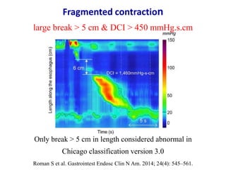 Normal & abnormal swallows in chicago classification version 3.0 | PPTX