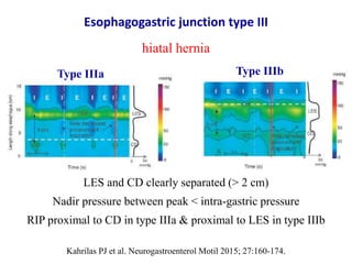 Esophagogastric junction type III
hiatal hernia
Type IIIbType IIIa
LES and CD clearly separated (≥ 2 cm)
Nadir pressure be...