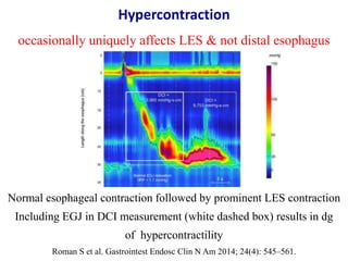 CDP in weak contraction & hypercontraction
Weak contraction Hypercontraction
Pandolfino JE et al. Neurogastroenterol Motil...