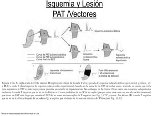 Isquemia y Lesión
PAT /Vectores
Manual de electrocardiografía básica Antoni Bayés de Luna
 