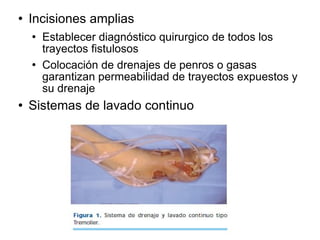  Incisiones amplias
 Establecer diagnóstico quirurgico de todos los
trayectos fistulosos
 Colocación de drenajes de penros o gasas
garantizan permeabilidad de trayectos expuestos y
su drenaje
 Sistemas de lavado continuo
 