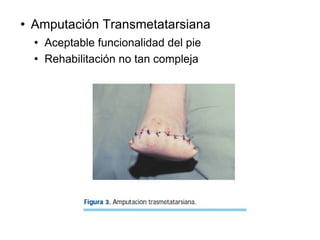  Amputación Transmetatarsiana
 Aceptable funcionalidad del pie
 Rehabilitación no tan compleja
 
