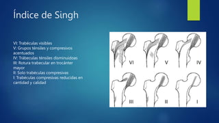 Índice de Singh
VI: Trabéculas visibles
V: Grupos ténsiles y compresivos
acentuados
IV: Trábeculas ténsiles disminuidoas
III: Rotura trabecular en trocánter
mayor
II: Solo trabéculas compresivas
I: Trabéculas compresivas reducidas en
cantidad y calidad